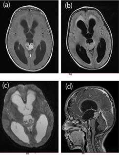 Papillary Tumor of Pineal Region; A Case Report
