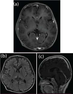 Figure 2. Eight Months Post Treatment MRI; (a) T1 Post-Contrast, (b) FLAIR, (c) Sagittal T1 Post-Contrast