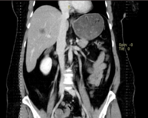 Multiple Hepatic Epithelioid Hemangioendothelioma; A Rare Case Report