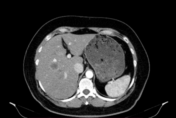 Figure 1. CT Scan Showing Hypovascular Lesion. (b)
