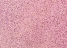 Figure 2. (A) Low Power View Showed Multiple cords of Cells with an Infiltrative Growth Pattern Set in a Dense Fibrohyalin Stroma. (B) High Power View, Showed Endothelial Cells with Large Nucleus, Prominent Nucleoli, Abundant Cytoplasm with Occasional Intracellular ‘Capillary’ Luminal Space. (a)