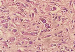 Figure 2. (A) Low Power View Showed Multiple cords of Cells with an Infiltrative Growth Pattern Set in a Dense Fibrohyalin Stroma. (B) High Power View, Showed Endothelial Cells with Large Nucleus, Prominent Nucleoli, Abundant Cytoplasm with Occasional Intracellular ‘Capillary’ Luminal Space. (b)
