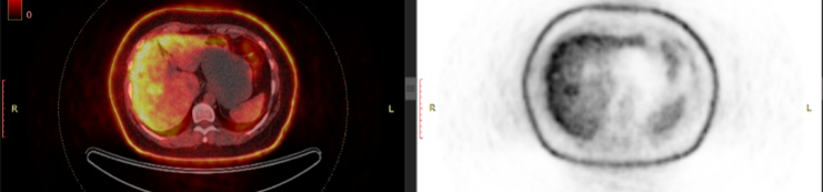 Figure 3. FDG PET Scan Showing an FDG Uptake Lesion in Segment 8. (a)