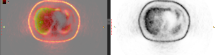 Figure 3. FDG PET Scan Showing an FDG Uptake Lesion in Segment 8. (b)