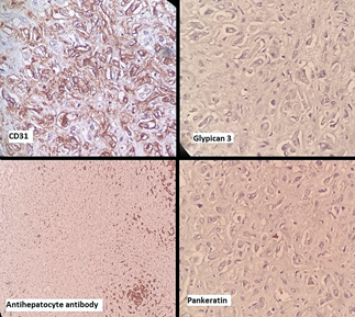 Figure 4. Immunohistochemical Staining Showed Strong Positivity for CD31 While Negative for Glypican 3, Antihepatocytes Antibody and Pankeratin.