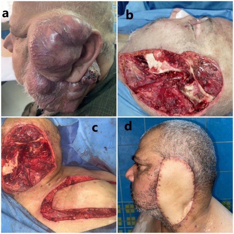 Surgical Excision of Huge Recurrent Parotid Carcinoma and Reconstruction Using Supraclavicular Artery Island Flap: A Case Report