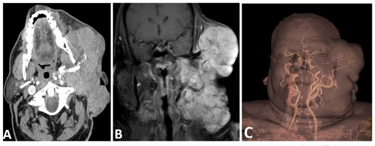 Figure 2. Post-Contrast CT and MR Examination of the Patient: (A) A large lobulated heterogeneously enhancing soft tissue mass is seen in the left parotid space totally encasing the terminal part of the left external carotid artery, (B) Coronal Post-contrast MR, shows the multi-spacial extension of the mass with suprazygomatic and temporal components superiorly and cervical space inferiorly, (C) 3D CT angiography of the mass shows the arterial supply from the superficial temporal artery.