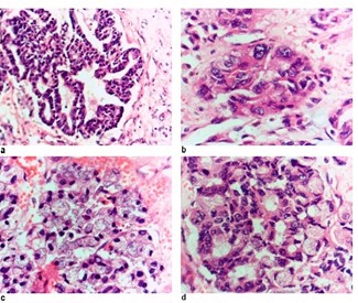 Figure 3. Microscopic examination of the tumor: (a) Glandular cells showing eosinophilic cytoplasm and vesicular nuclei. The cells are arranged in solid sheets and acinar pattern (X200), (b) Intercalated duct-like cells that are cuboidal & polygonal showing abundant eosinophilic cytoplasm and centrally-placed pleomorphic nuclei. The cells are arranged in solid sheets (HX&Ex400), (c) Solid sheet of acinar cells large polygonal cells with abundant basophilic granular cytoplasm and eccentric small hyperchromatic nuclei. (HX&Ex400), (d) Mixture of non-specific glandular cells and basophilic cells. The cells are arranged in acinar & solid sheet patterns. (HX&Ex400).