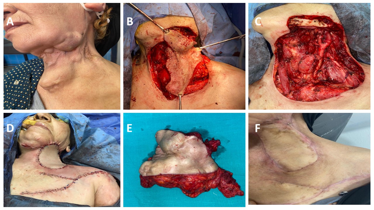 Radical Resection and Deltopectoral Flap Reconstruction Solving the Dilemma of Repeatedly Recurring Submandibular Pleomorphic Adenoma: A Case Report