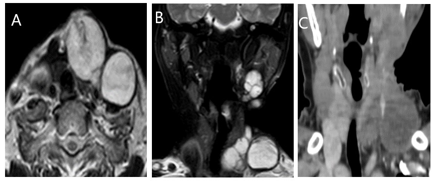 Figure 2. MR and Post-Contrast CT Examination of the Patient Revealed: (A) Axial T2 Lobulated Lesion at the Left Supraclavicular Region with Hypointense Rim Wall Compressing Related Vessels Posteriorly. (B) Coronal SPAIR MR, Shows Multiple Lesions Seen at the Left Side of the Neck Submandibular and Left Supraclavicular Region. (C) Post-Contrast Coronal CT Show Mildly Enhancing Lesions at the Left Supraclavicular Region Encasing the Left Internal Jugular Vein.