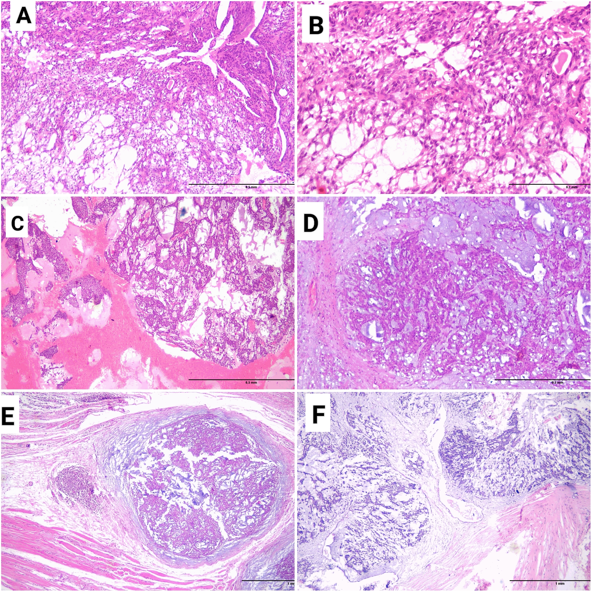 Figure 3. (A&B): Microscopic Picture of the Primary Tumor Showed the Biphasic Appearance with Epithelial, Myoepithelial, and Stromal Components (H&E, x40 & x200 Respectively). (C-F): Images from the First, the Third, the Fourth, and the Last Recurrences Respectively (H&E, x40, x200, x40 & x40 Respectively).